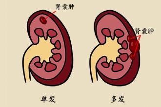 肾囊肿的症状有哪些-肾囊肿的症状表现及治疗方法