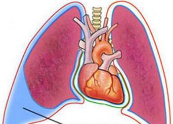 胸膜炎的症状有哪些-胸膜炎有什么症状