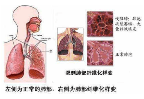 什么是肺部纤维化-肺部纤维化怎么回事