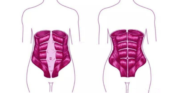 腹直肌分离怎么恢复-腹直肌分离怎么恢复训练