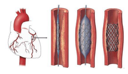 做心脏支架后的最长寿命是多少年-做心脏支架后的寿命是多少