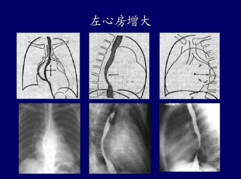 左心房增大是什么意思-左心房增大怎么回事