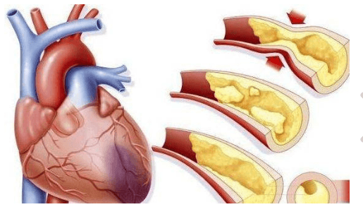 心肌缺血怎么办-心肌缺血如何处理