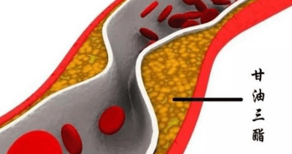 甘油三酯高是怎么回事-甘油三酯高是什么原因
