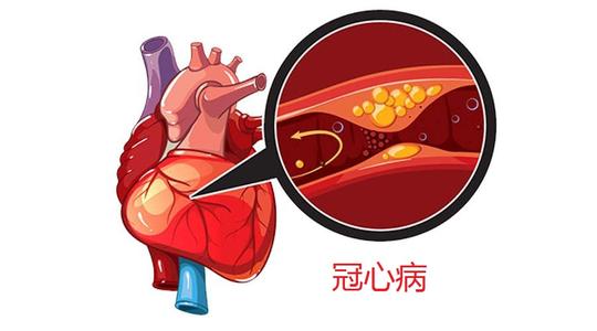 冠心病有哪些症状表现-冠心病有什么症状表现