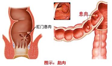 肛门长了肉球怎么办-肛门长了肉球是什么原因