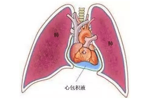 心包积液原因-心包积液怎么回事