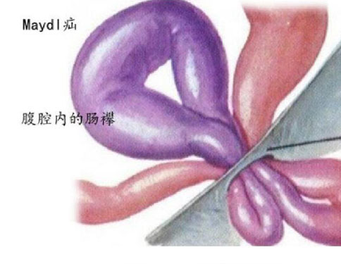 疝气症状有哪些-疝气有哪些症状