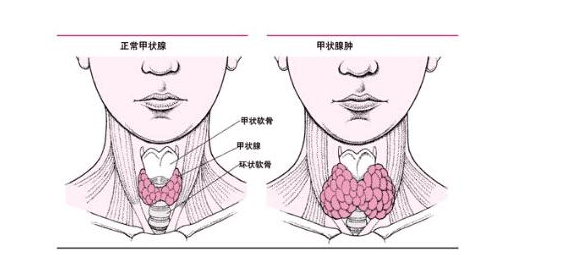 甲状腺炎有哪些典型症状-甲状腺炎有哪些典型症状有哪些