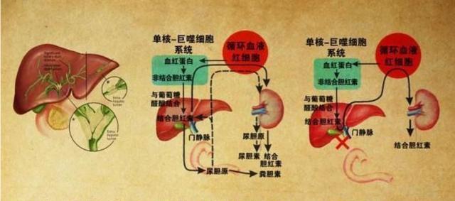 胆红素偏高是什么病-胆红素偏高什么原因造成的