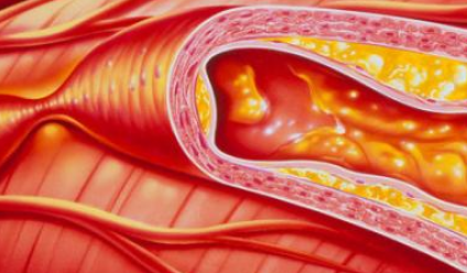 动脉硬化的原因及治疗-动脉硬化的原因及治疗方法