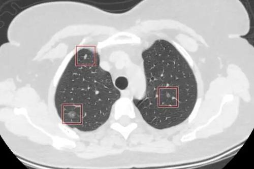 肺部4mm结节要紧吗-肺部4mm结节要不要紧