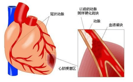 心肌缺血会自愈吗-心肌缺血可不可以自愈