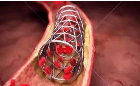 心脏支架后多长时间恢复正常-心脏支架后多长时间能能好