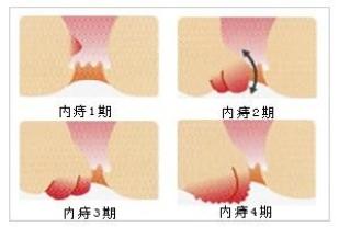 什么是痔疮-痔疮是什么