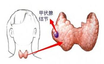 甲状腺结节治疗最佳方法-甲状腺结节治疗方法是什么