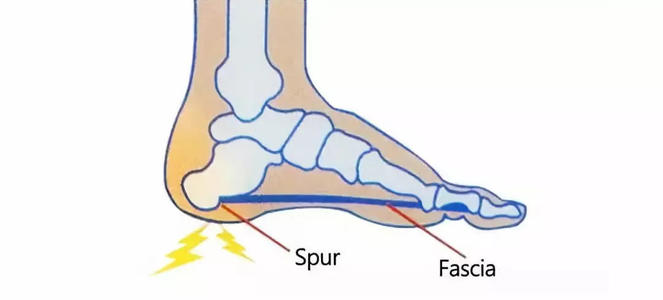 后脚跟痛是怎么回事-引起后脚跟痛的原因有哪些