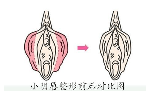 正常阴唇的形态-正常阴唇的形态介绍