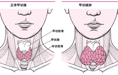 甲状腺手术费用是多少-甲状腺手术费用要多少钱