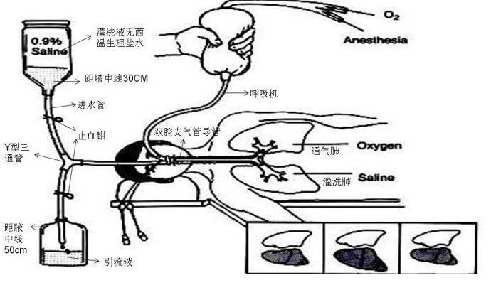 洗肺多少钱一次-洗肺一次要多少钱