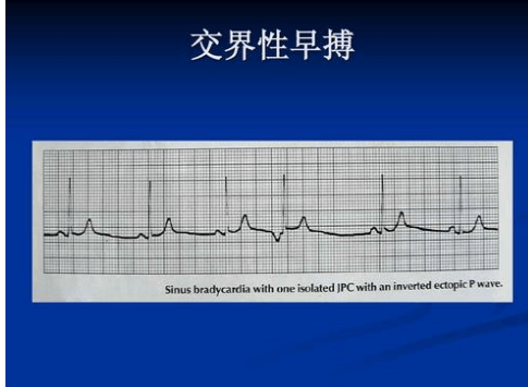 早搏最好的治疗方法是什么-早搏怎么治疗最佳