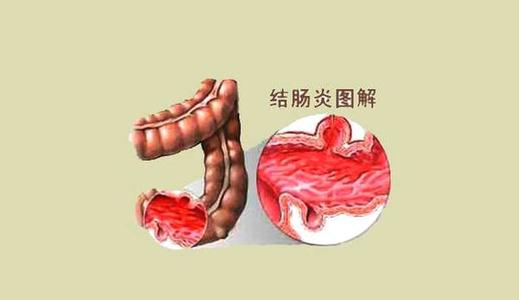 治慢性结肠炎的中成药-治慢性结肠炎最佳中成药推荐
