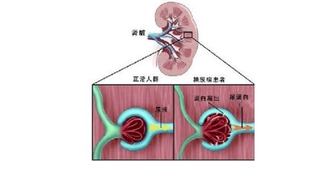 糖尿病肾病分期标准5期-糖尿病肾病标准5期是哪5期