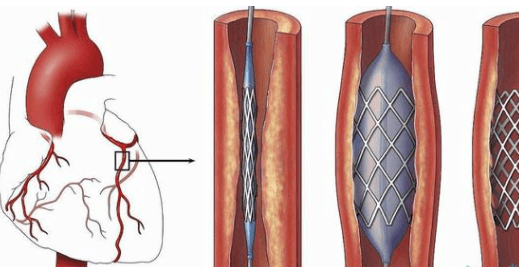 做过心脏支架的人最多能活几年-做过心脏支架的人还能活多久