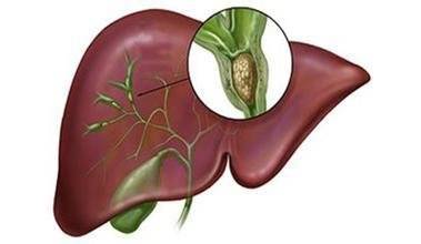 胆囊摘除后遗症有哪些-胆囊摘除后可能出现的后遗症