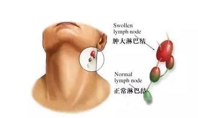 淋巴结发炎吃什么药见效最快-淋巴结发炎吃什么药比较好