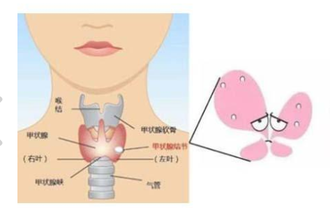 甲状腺结节3级严重吗-甲状腺结节3类是什么严重吗