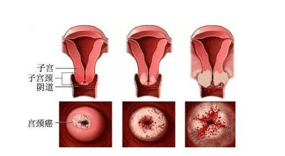 宫颈癌疼痛是哪里疼-宫颈癌疼痛位置相关介绍
