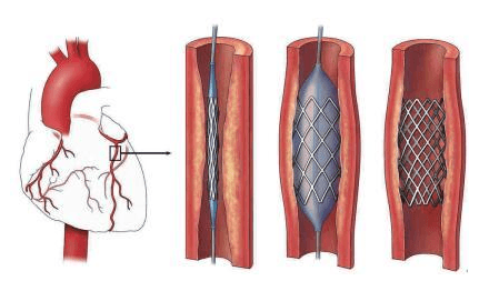 做心脏支架后的最长寿命是多少年-做心脏支架后的最长多久