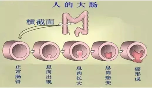 肠息肉的早期症状有哪些常见的-肠息肉的早期症状有哪些