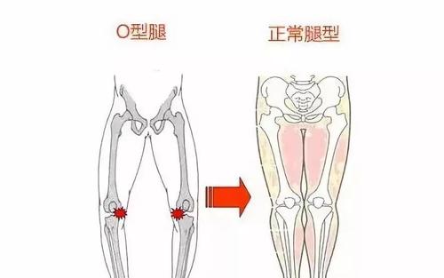 大腿根部与胯连接处疼怎么回事-导致大腿根部与胯连接处疼的原因有哪些