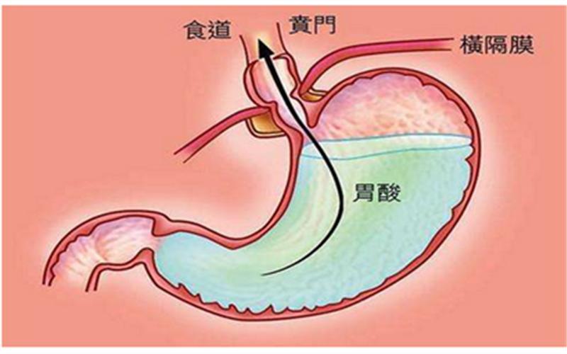 胃灼烧反酸吃什么药-适合胃灼烧反酸的3种中成药