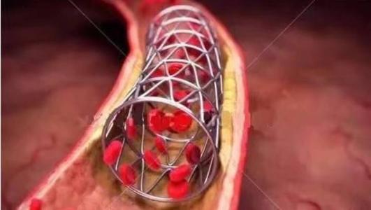 做心脏支架的危害-做心脏支架有什么危险