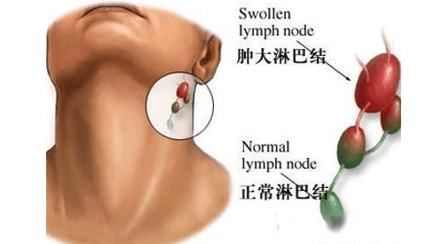 淋巴结一直不消正常吗