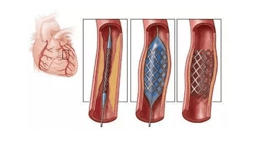 做完心脏支架最怕什么-做完心脏支架最怕做什么