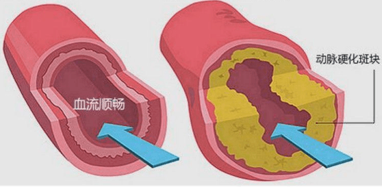 动脉硬化坚持走路一年可逆转