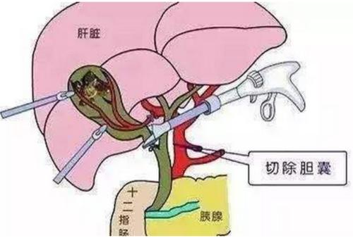 胆切除了能活多久-胆切除了能活多长时间