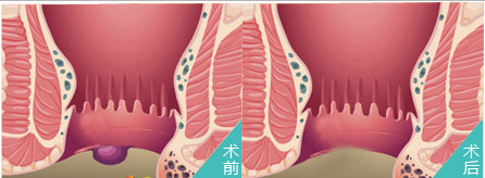 痔疮手术后多久完全恢复-痔疮手术需要恢复多久