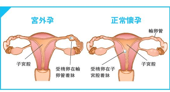 宫外孕怎么办处理方法-宫外孕处理方法介绍说明