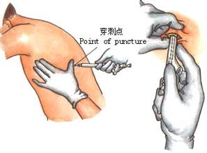 穿刺是什么-穿刺介绍