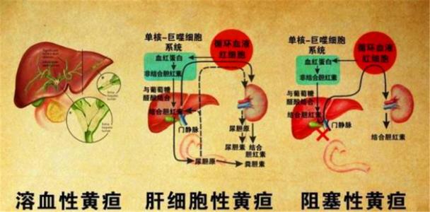 总胆红素偏高是什么原因-总胆红素偏高是怎么一回事