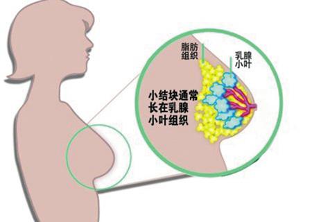 导致患上乳腺癌的七大诱因 体重超标运动太少