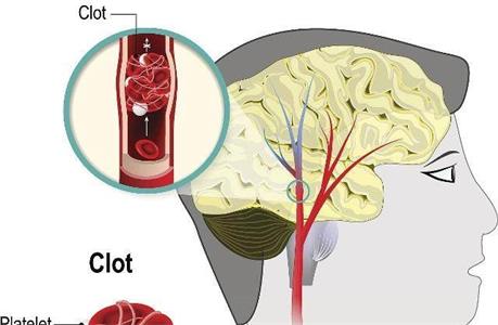 脑梗塞的症状是什么-脑梗塞的症状都有哪些前期症状