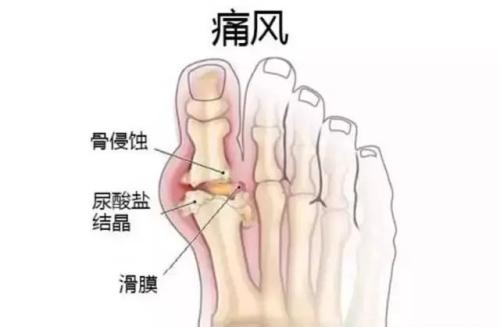 这几种食物多吃专防高尿酸，让你远离痛风