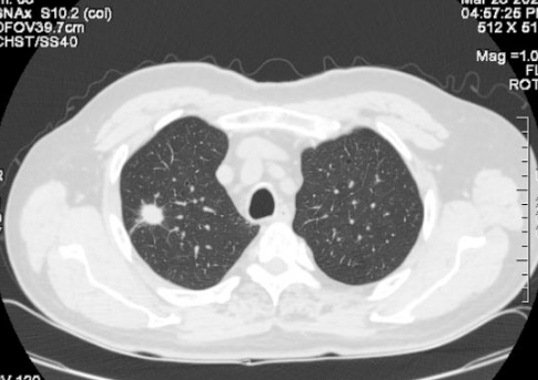 肺结节10个人9个人有吗真的吗-为什么体检查出肺部有结节的人越来越多