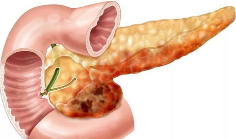 胰腺炎轻微疼痛怎么办-胰腺炎又发作了在家怎么办